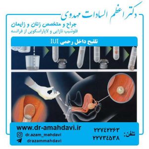 تلقیح داخل رحمی