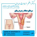 سرطان دهانه رحم در زنان