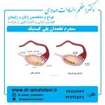 سندرم تخمدان پلی کیستیک