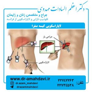 لاپاراسکوپی-کیسه-صفرا