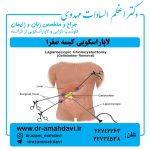 لاپاراسکوپی کیسه صفرا
