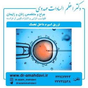 تزريق اسپرم داخل تخمك