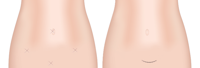 تفاوت جراحی باز با لاپاراسکوپی