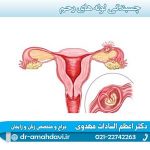 چسبندگی-لوله-های-رحم
