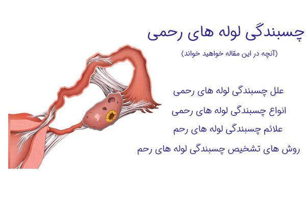 چسبندگی لوله های رحمی