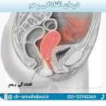 درمان-افتادگی-رحم