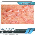 سیفیلیس در بارداری