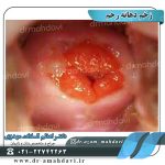 عکس زخم-دهانه-رحم