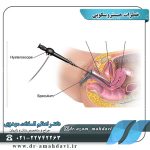 خطرات هیستروسکوپی