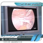 تصاویری از اندومتریوز