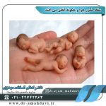 سقط مکرر چرا و چگونه اتفاق می افتد