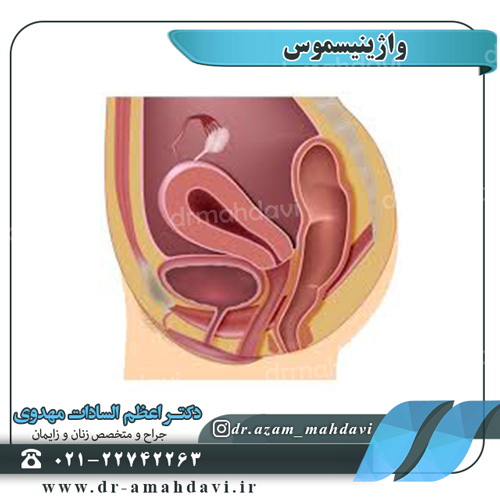 واژینیسموس