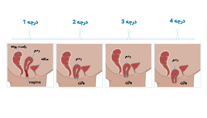 علائم افتادگی اندامهای  لگن چیست؟ 