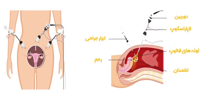 آشنایی با ابزار و روش لاپاراسکوپی