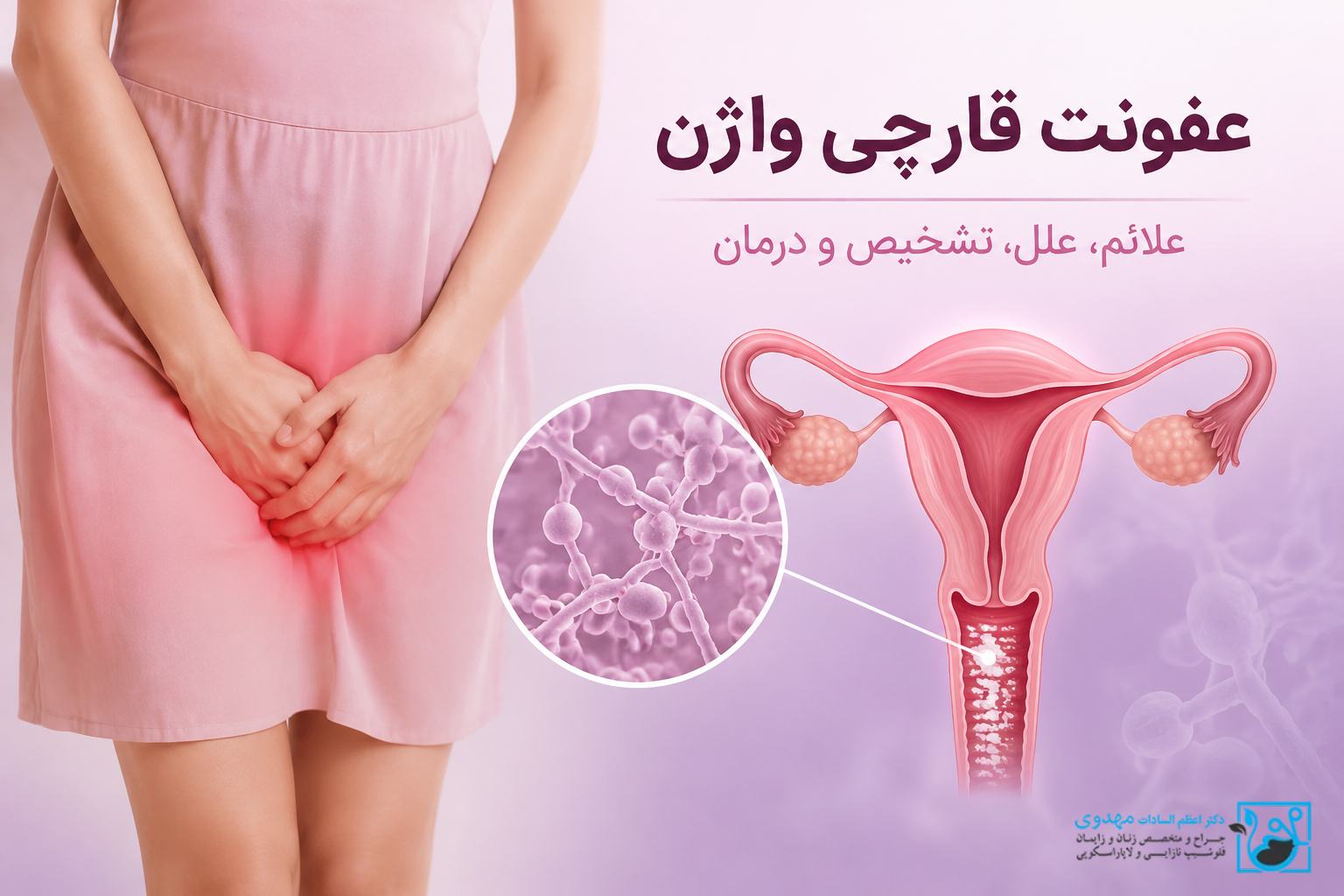 عفونت قارچی واژن