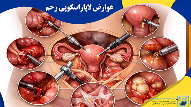 عوارض لاپاراسکوپی رحم عوارض لاپاراسکوپی رحم