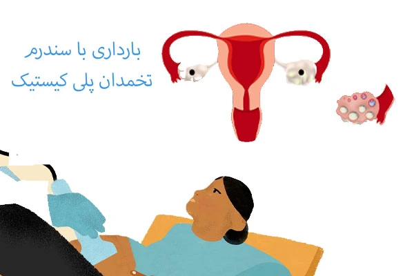 بارداری با سندرم تخمدان پلی کیستیک