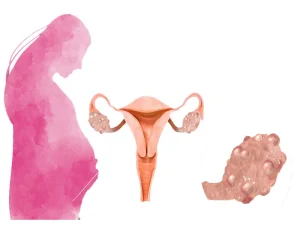 تاثیر سندرم تخمدان پلی کیستیک بر باروری