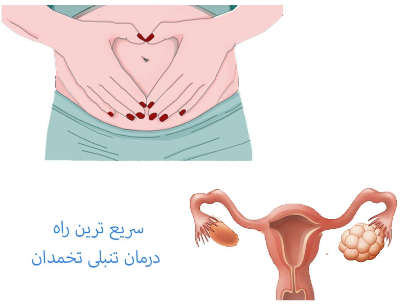 سریع ترین راه درمان تنبلی تخمدان