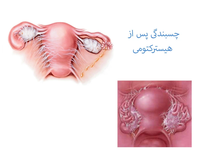 چسبندگی پس از هیسترکتومی