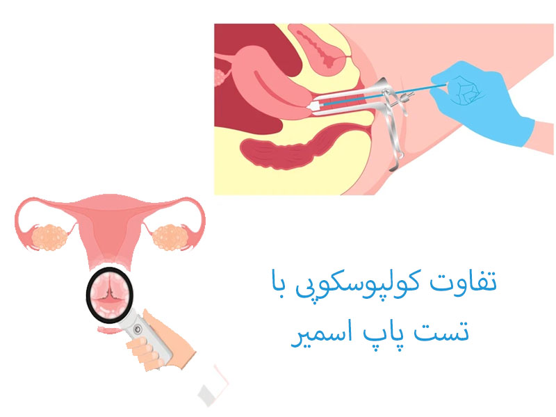 فرق پاپ اسمیر با کولپوسکوپی