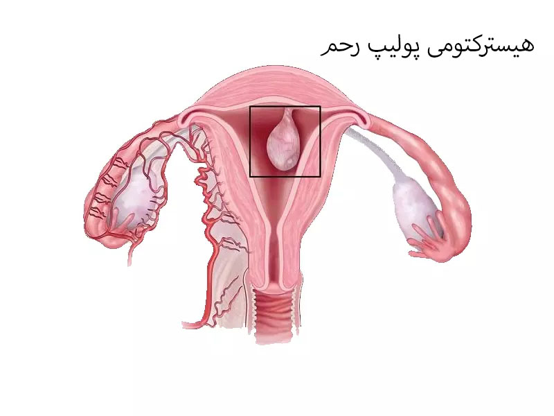 جراحی هیسترکتومی پولیپ رحم