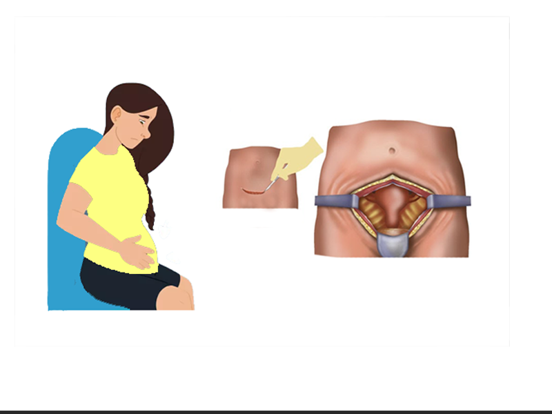 تغییر شکل واژن بعد هیسترکتومی