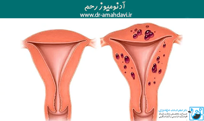 آدنومیوز رحم