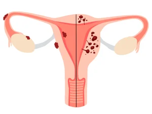 درمان آدنومیوز رحم