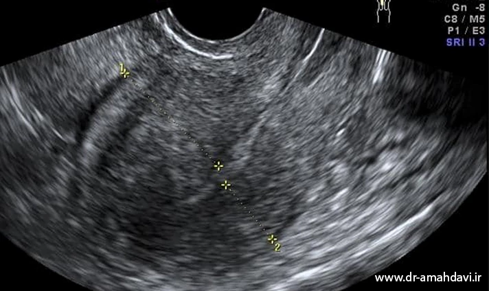 علائم آدنومیوز رحم