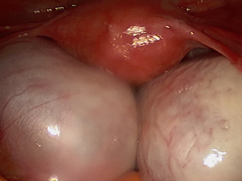 عکس لاپاراسکوپی کیست تخمدان