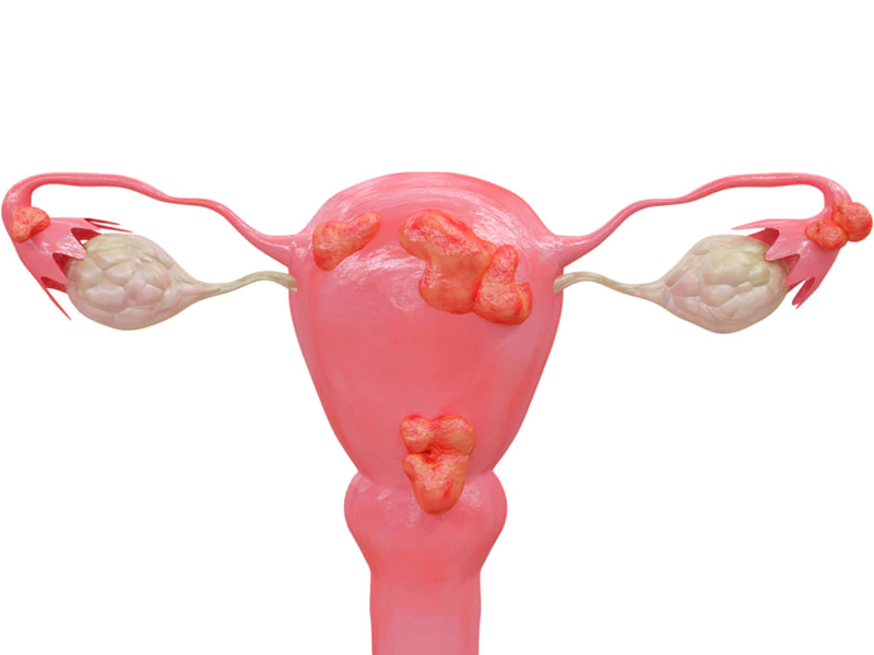 اندومتریوز چیست؟