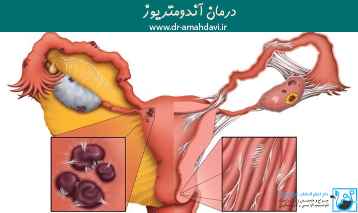 درمان آندومتریوز