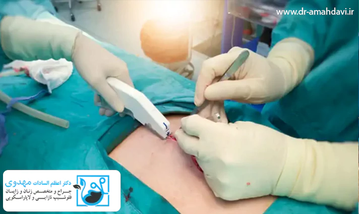 تفاوت لاپاراسکوپی و لاپاراتومی در کاندیدای مناسب