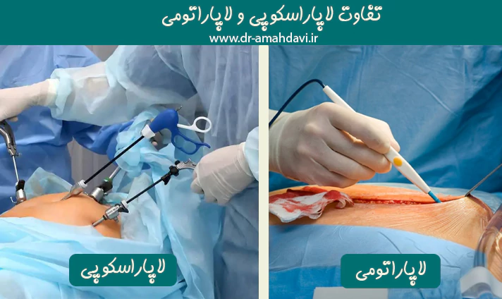 تفاوت لاپاراسکوپی و لاپاراتومی