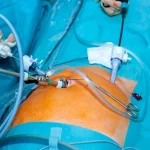 لاپاراسکوپی هیسترکتومی