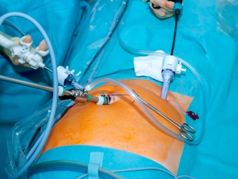 لاپاراسکوپی هیسترکتومی