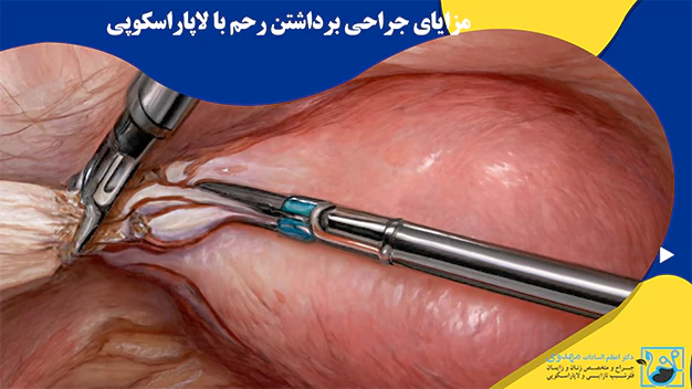 مزایای جراحی برداشتن رحم با لاپاراسکوپی