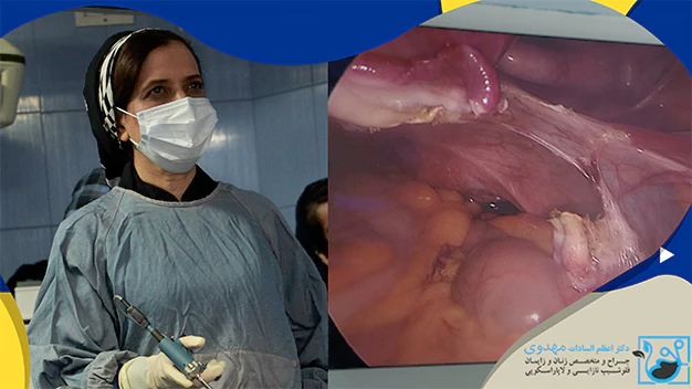 زمان مراجعه به فوق تخصص لاپاراسکوپی رحم