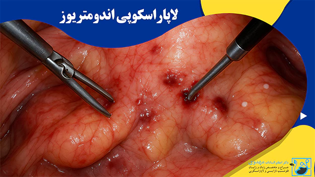 لاپاراسکوپی اندومتریوز
