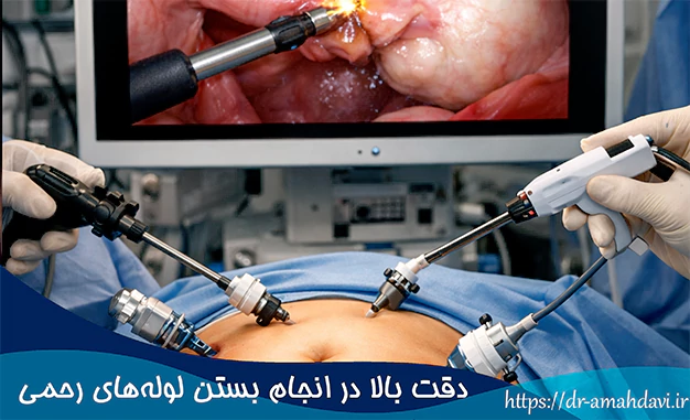 دقت بالا در انجام بستن لوله‌های رحمی
