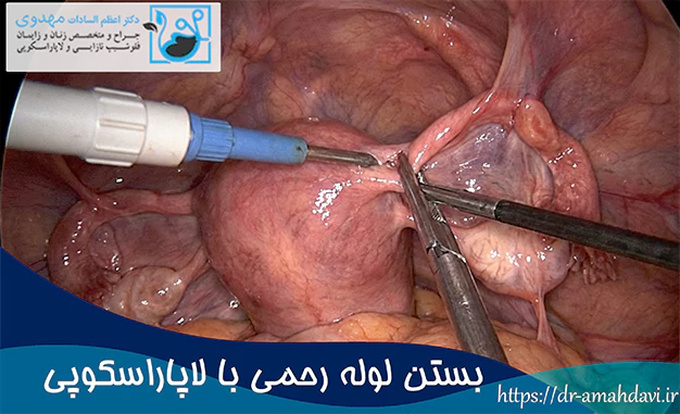 بستن لوله رحمی با لاپاراسکوپی