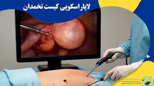 لاپاراسکوپی کیست تخمدان لاپاراسکوپی کیست تخمدان