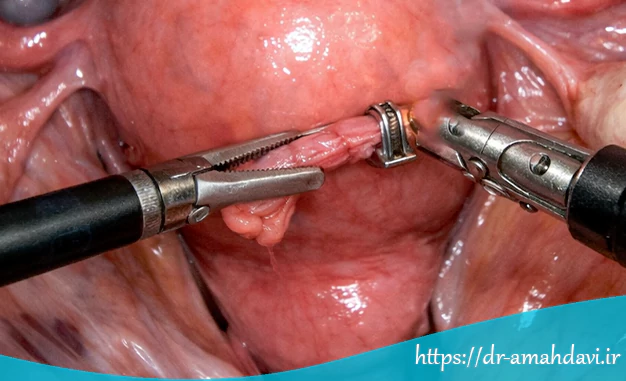 مراحل انجام بستن لوله رحمی با لاپاراسکوپی