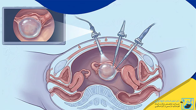 کاندیدای مناسب برای لاپاراسکوپی کیست تخمدان کاندیدای مناسب برای لاپاراسکوپی کیست تخمدان