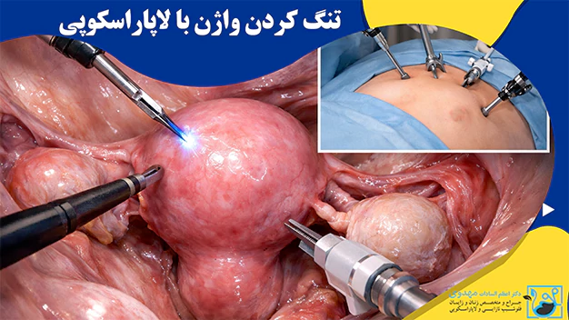 تنگ کردن واژن با لاپاراسکوپی