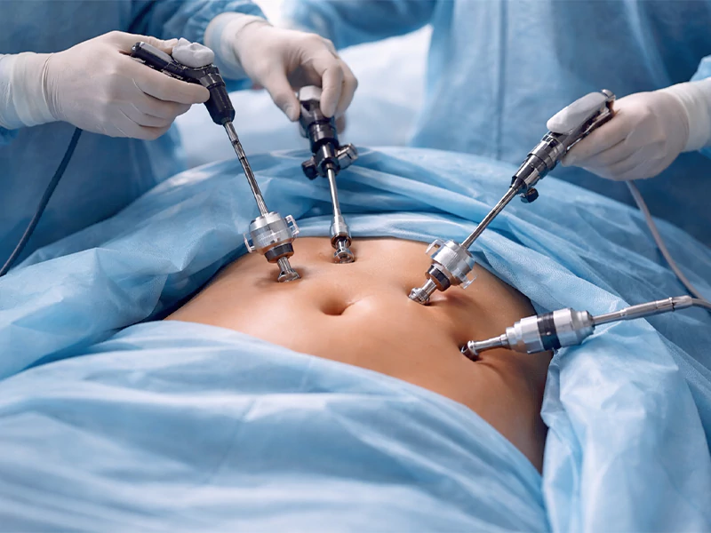 لاپاراسکوپی تنگ کردن واژن